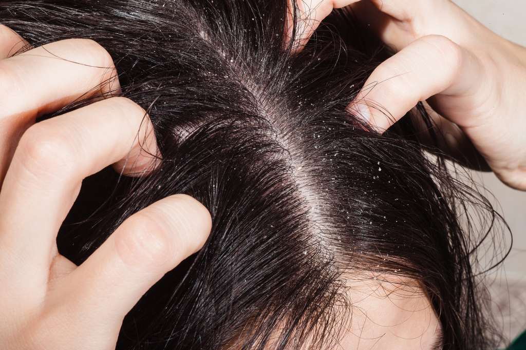 A person with an itchy scalp and dandruff.