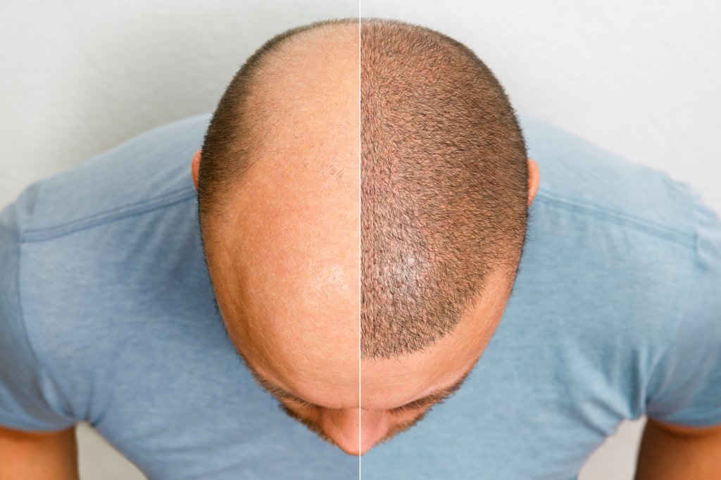 Hair regrowth is depicted on a bald head.